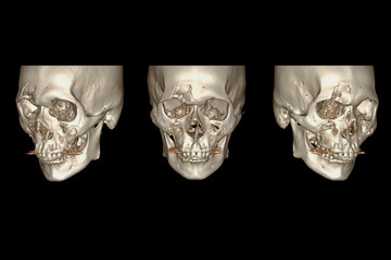 CT Facial Bone 3D rendering  image isolated on black background showing fracture frontal bone .