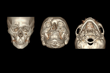CT Facial Bone 3D rendering  image isolated on black background showing fracture frontal bone . © samunella