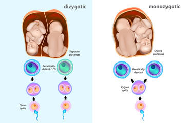 Monozygotic or dizygotic twins. Types of twins - obrazy, fototapety, plakaty