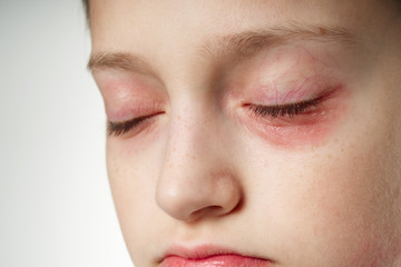 Allergic reaction, skin rash, close view portrait of a girl's face. Redness and inflammation of the...