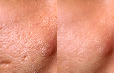 Comparison of skin before and after laser resurfacing. Skin with acne, acne scars, enlarged pores.