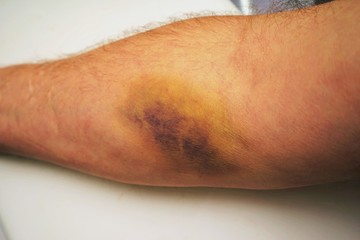 A bruise on the forearm caused by a syringe