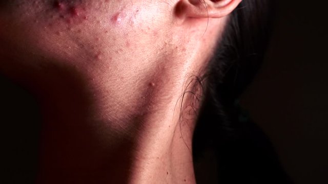 Skin problem - Young Woman who suffers severe acne - Macro -  Touching the face with a hand.