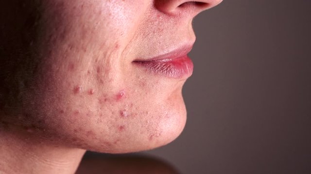 Skin problem - Young Nervous Woman who suffers severe acne - Macro - Sends air kisses and showing her teeth and lips.