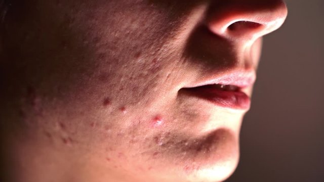 Skin problem - Young Woman who suffers severe acne - Macro - Woman being nervous and smiles. Procedure Concept.