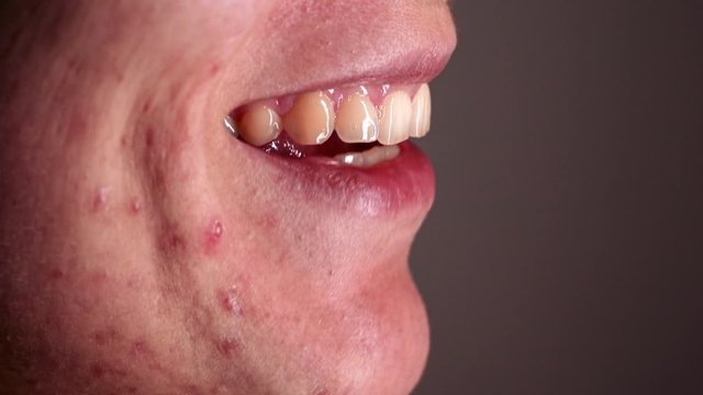 Skin problem - Young Woman who suffers severe acne - Macro - At the end of the video, she turns her head.