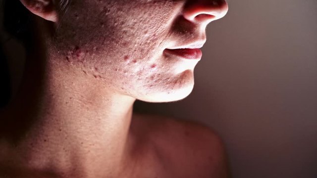 Skin problem - Young Woman who suffers severe acne - Macro - At the end of the video, she turns her head.