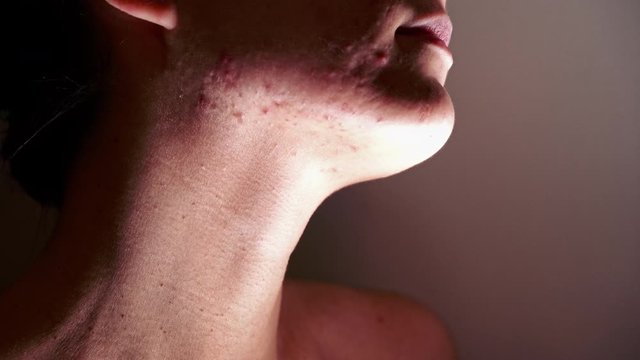 Skin problem - Young Woman who suffers severe acne - Macro - At the end of the video, she turns her head.