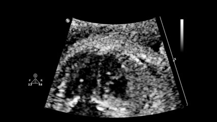 Ultrasound screen with fetal echocardiography.