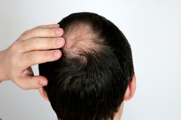 Fototapeta premium Baldness, man concerned about hair loss. Male head with a bald on white background