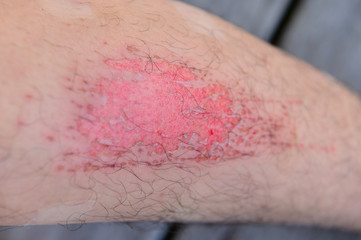 Closeup human legs with fresh wound