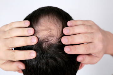 Fototapeta premium Baldness, man concerned about hair loss. Male head with a bald on white background