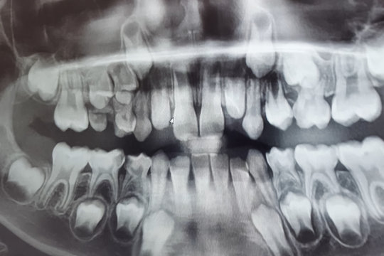 X-RAY PICTURE OF DAIRY AND NEW CHILDRENS TEETH.