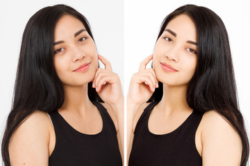 Before after close up asian woman face with dark circles under eyes and problem skin. Beauty skin care treatment. Before-after Facial problems. Dermatology cosmetology changing procedures.