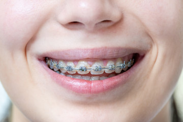 Medical dental braces