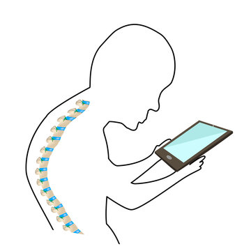 recommend clip art: Text Neck Syndrome. Spinal curvature, kyphosis, lordosis of the neck, scoliosis, arthrosis. Improper posture and stoop. Linear silhouette icon. Infographics. Vector illustration on isolated background