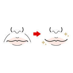 法令線　整形　ハリ　たるみ　ビフォーアフター