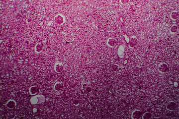 Diffuse sclerosing glomerulonephritis