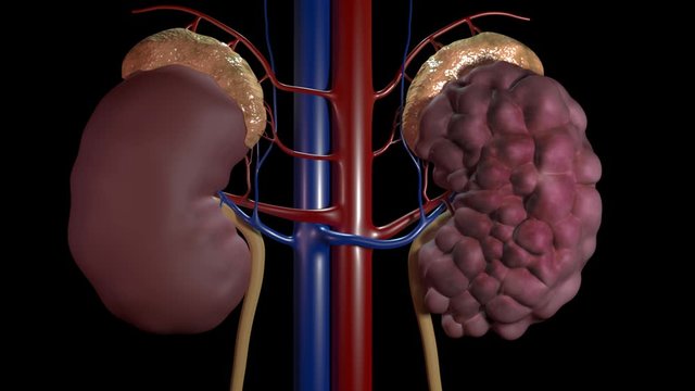 Polycystic Kidney