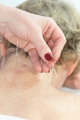 Elderly woman undergoing acupuncture procedure in a spa.