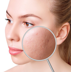 Magnifying glass shows skin before and after postacne treatment.