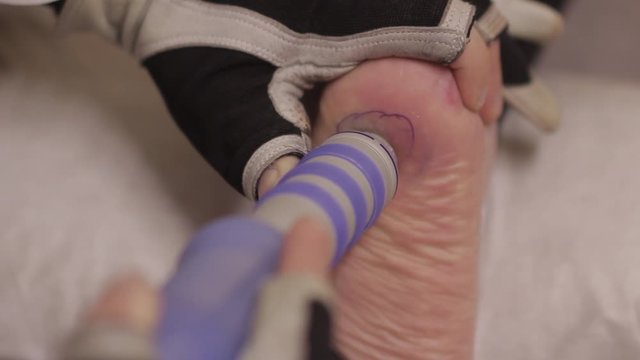 removal of heel spur by shock wave therapy