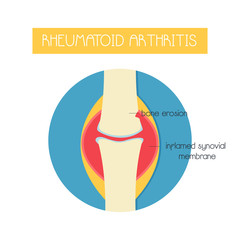 Illustration of a bone with rheumatoid arthritis.