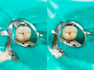 two chewing side teeth of the upper jaw after treatment of caries. Restoration of the chewing surface with a photopolymer filling material using the Rubber Dam system © Сергей Кучугурный