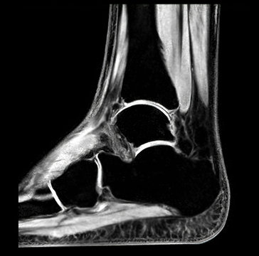MRI Ankle  Sagittal view showing black bone for diagnostic tendon injury.
