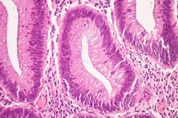 View in microscopic of ductal cell carcinoma, adenonocarcinoma from human breast cancer, tissue...