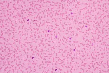Human blood smear view in microscopy.Complete blood count for treatment. Polymorphonuclear...