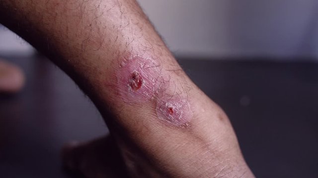 Skin disease, leg ulcers in men, eczema in the legs,Blisters caused by allergies