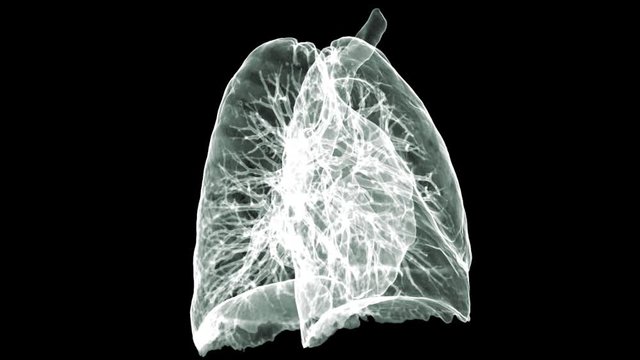 CT Chest  3D rendering image turn around on the screen for diagnostic  lung cancer .