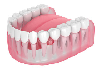 3d render of jaw and teeth with cyst