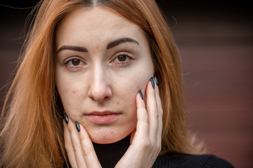 Acne and scars, simple woman close up natural portrait, No makeup and retouch. Problem skin