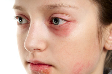 Fototapeta premium Allergic reaction, skin rash, close view portrait of a girl's face. Redness and inflammation of the skin in the eyes and lips. Immune system disease.