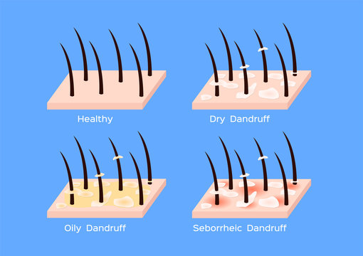 Dandruff on hair vector , closeup on skin vector , seborrhea