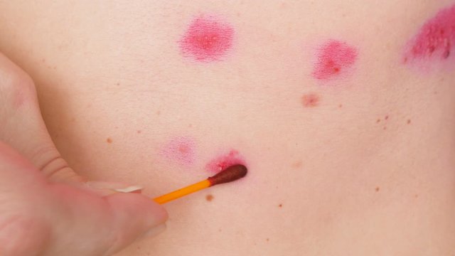 skin rash treatment on woman body. Shingles, Disease, Herpes zoster, varicella-z