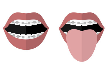 Open mouth with braces and tongue sticking out. Vector image. Flat design