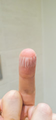 Skin Maceration on a white adult males hand after leaving a plaster or band aid on over night after a cut