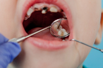 Close up of dentist's hands with assistant in blue gloves are treating teeth to a child, patient's face is closed
