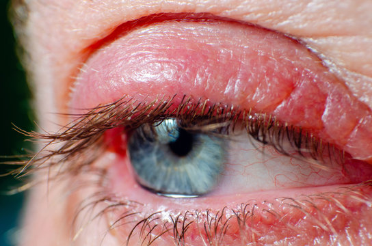 Irritated infected red bloodshot eye, barley infection in the eye