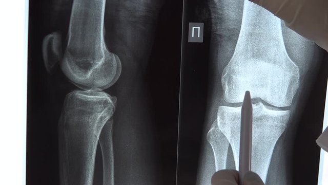 The doctor checks the results of an x-ray of the knee joint. The doctor examines the image of the x-ray and shows special places in the image with a pen.