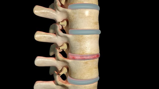 Spondylolisthesis