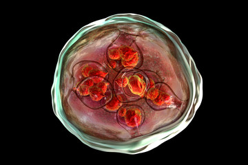 Hydatid cyst of Echinococcus granulosus