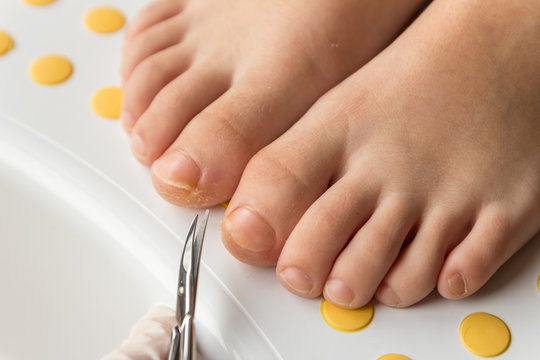 Feet with fungal toe nail infection