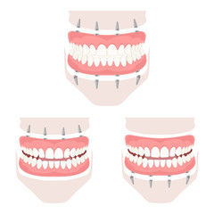 Removable denture of the upper and lower jaw.