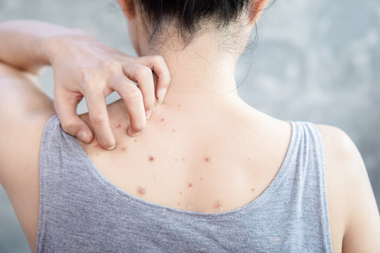 woman hand scratching her skin itchy because of acne , having problem dark and red spots on back