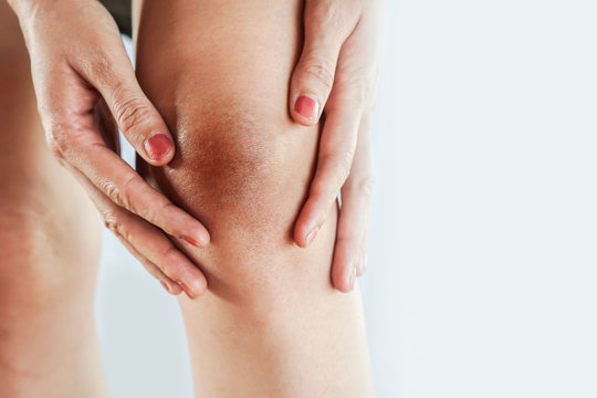 woman having problem with dark and wrinkle skin on knee
