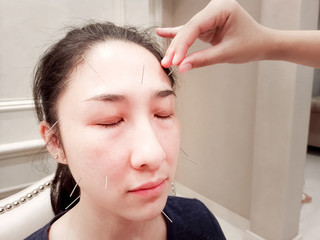 Naklejka premium Doctor sticks needles into the body on acupuncture . Acupuncture needles showing acupuncture points on human body to heal and relax therapy. Body Acupuncture Science in Traditional Chinese Medicine.